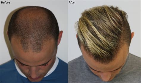 hair transplant cost in dubai.